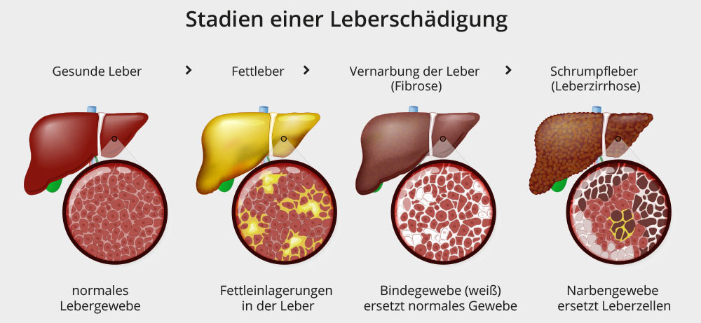 Stadien einer Leberschädigung