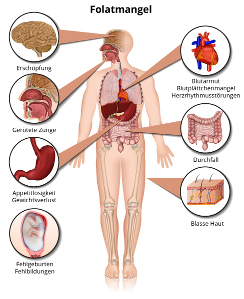 Folatmangel